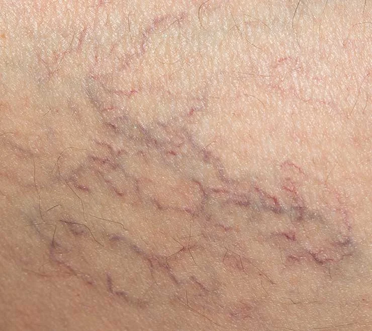 Laser or Sclerotherapy Treatment for Spider Veins
