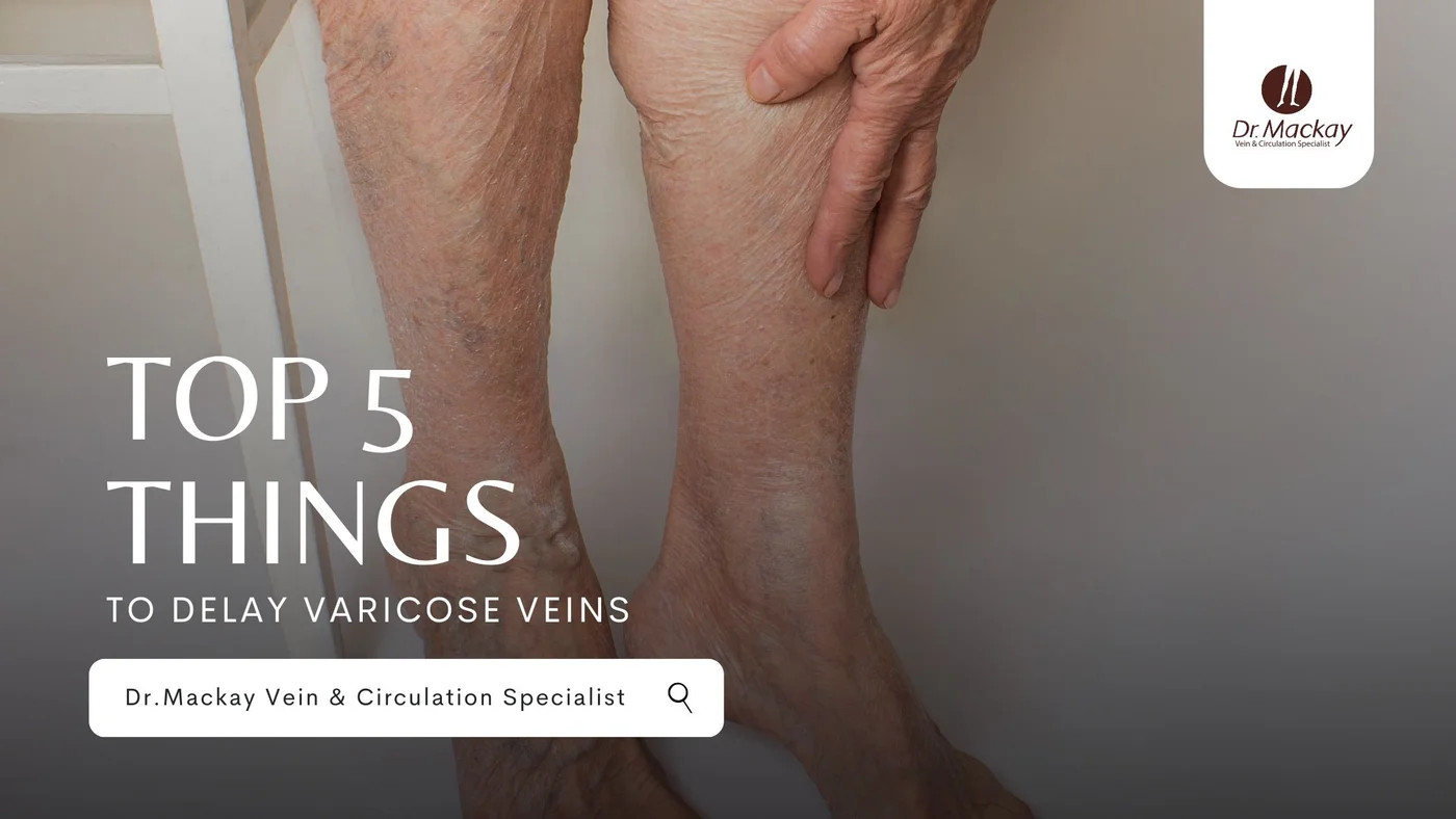 Top 5 Things to Delay Varicose Veins