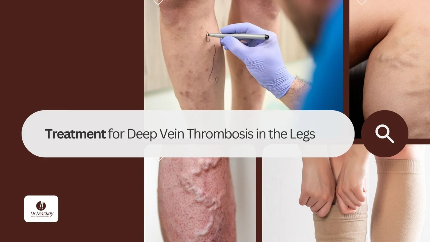 Treatment for DVT in the legs - Blog by vein surgeon Edward Mackay in Tampa area