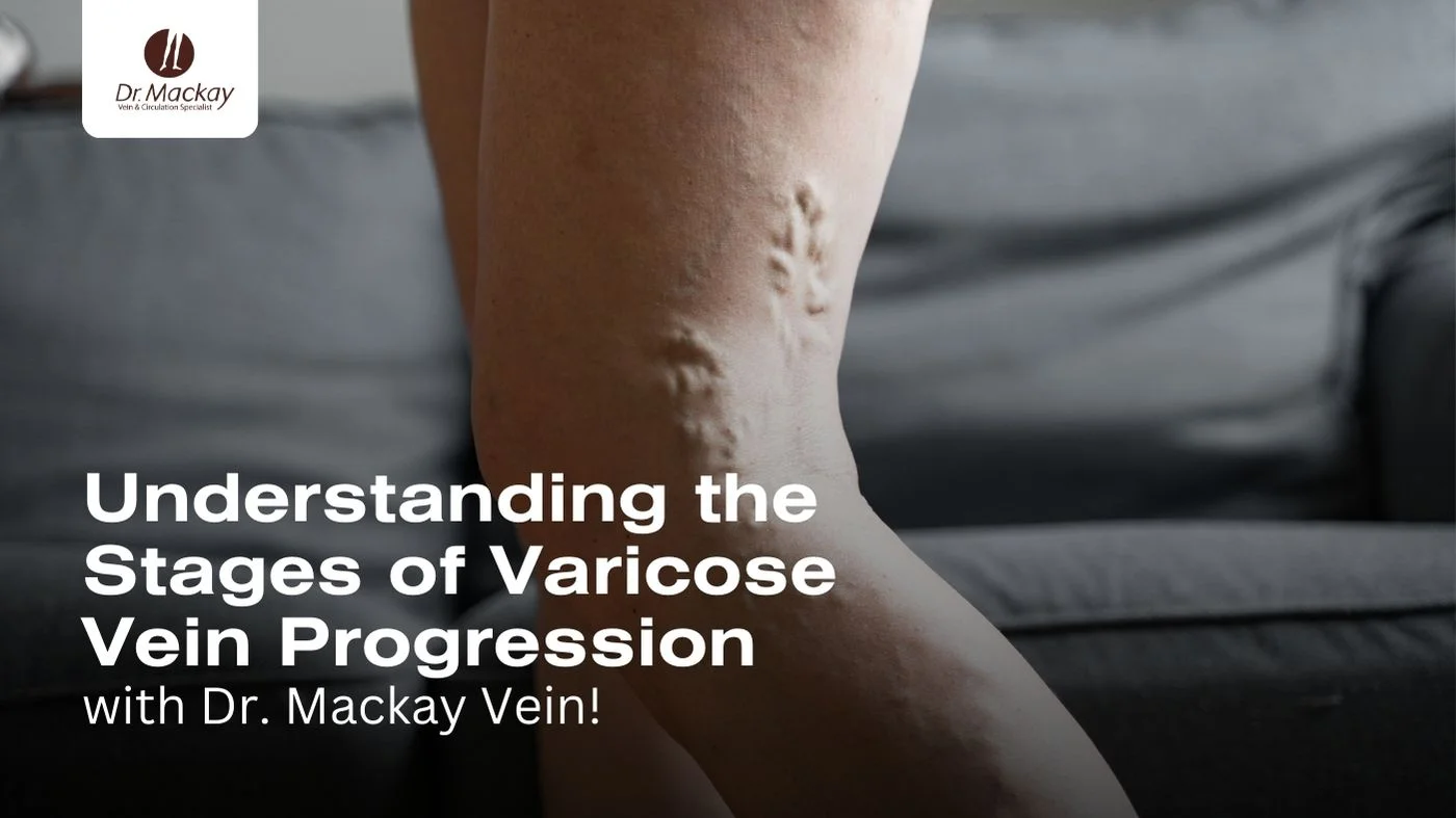 Varicose vein stages blog banner mackay st pete tampa