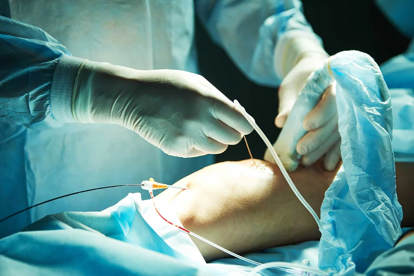 What is the Recovery Time for Vascular Surgery?