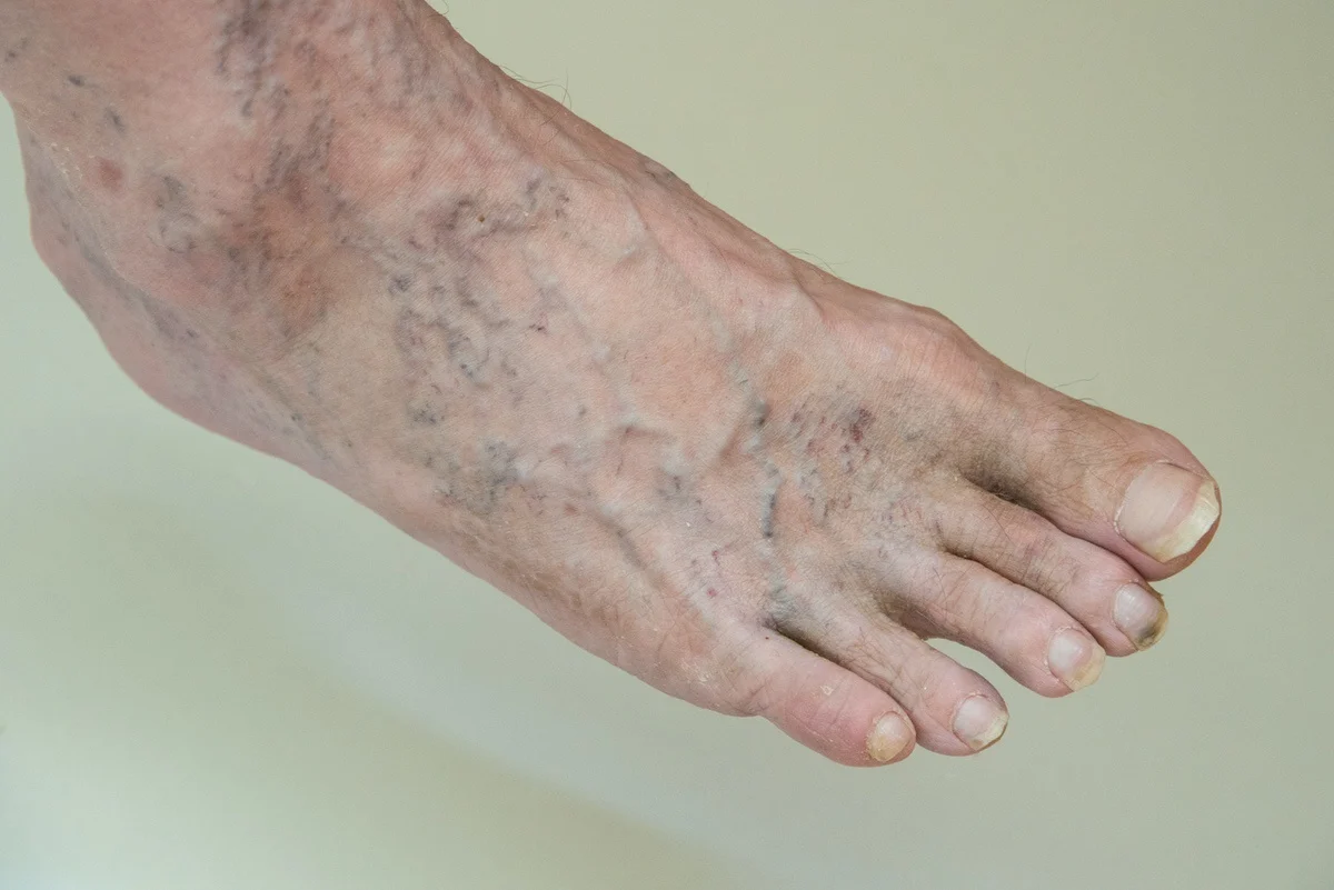 Feet Varicose Veins