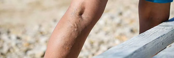 varicose-veins-md