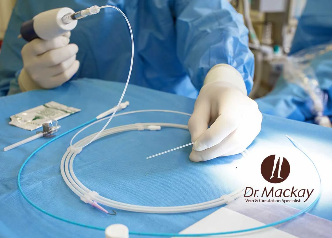 About Varicose Vein Surgery and the Options