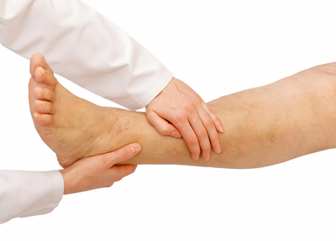 Leg Varicose Veins