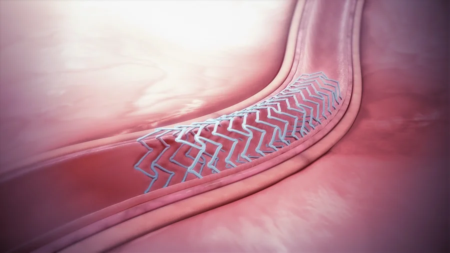 vein stenting illustration