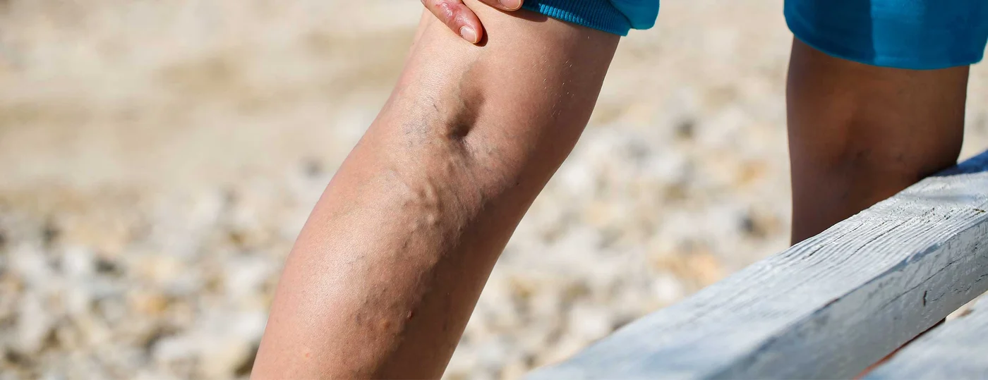 What are Varicose Veins?