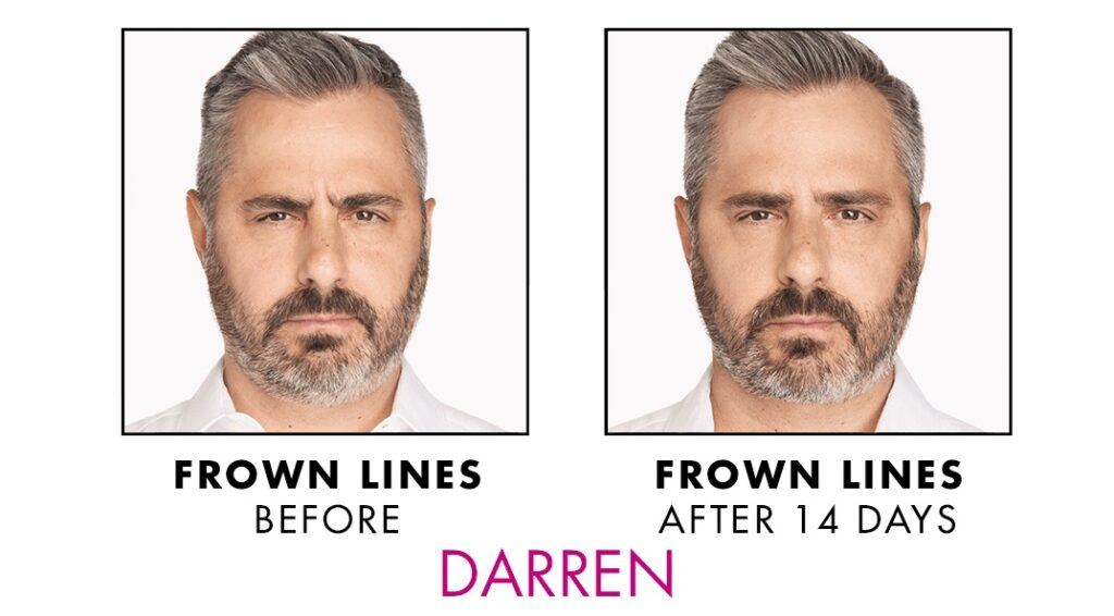 Xeomin before and after man 1