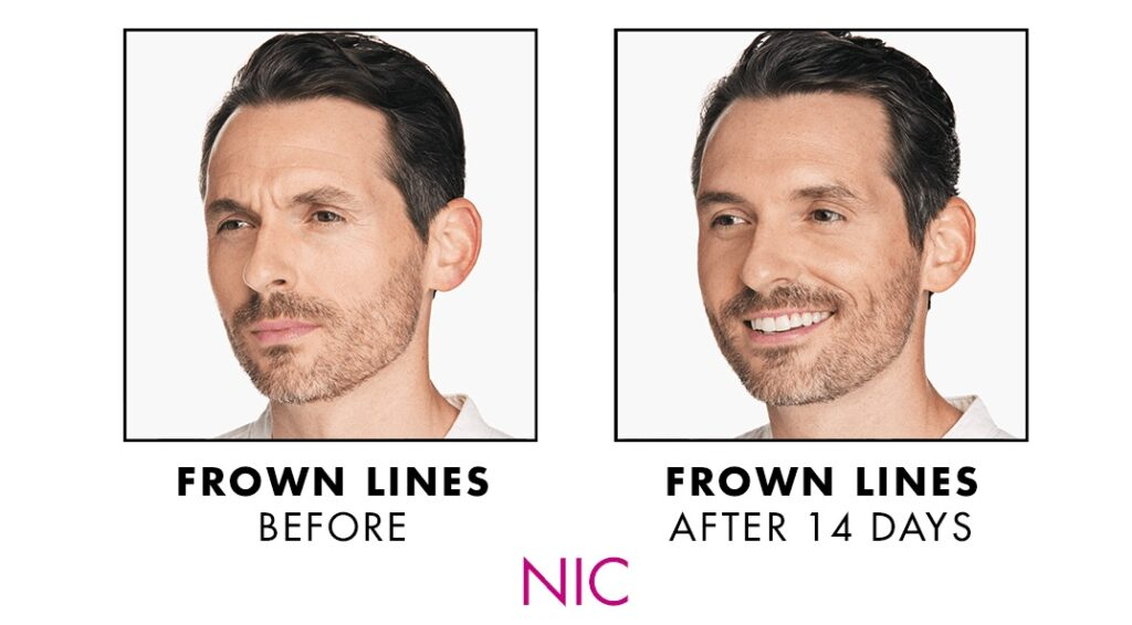 Xeomin before and after man 2