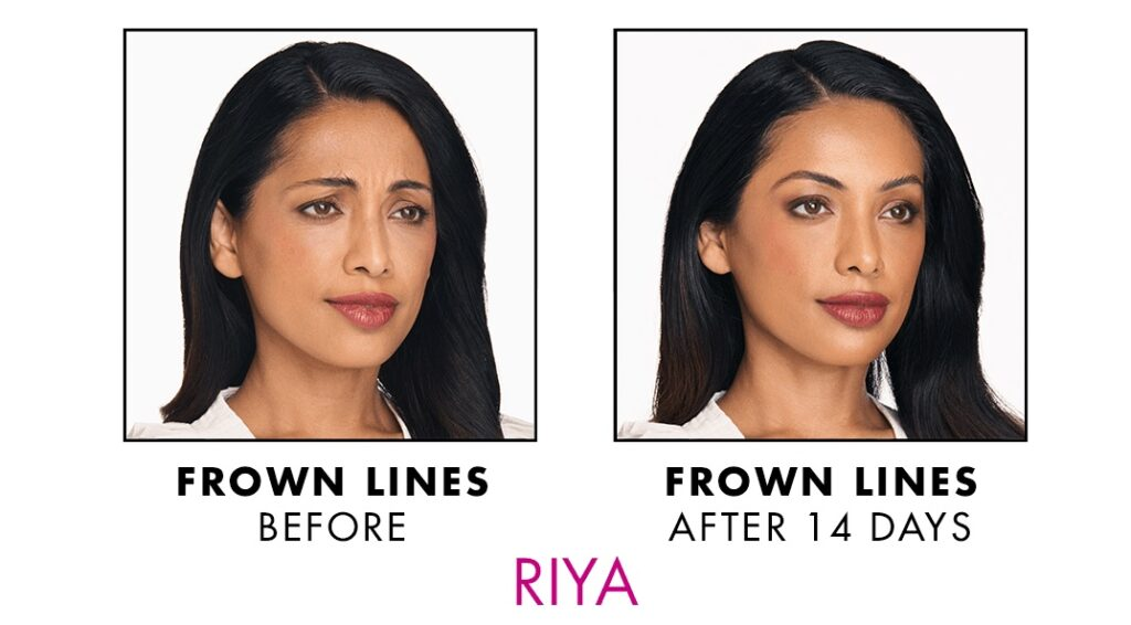 Xeomin before and after woman 1