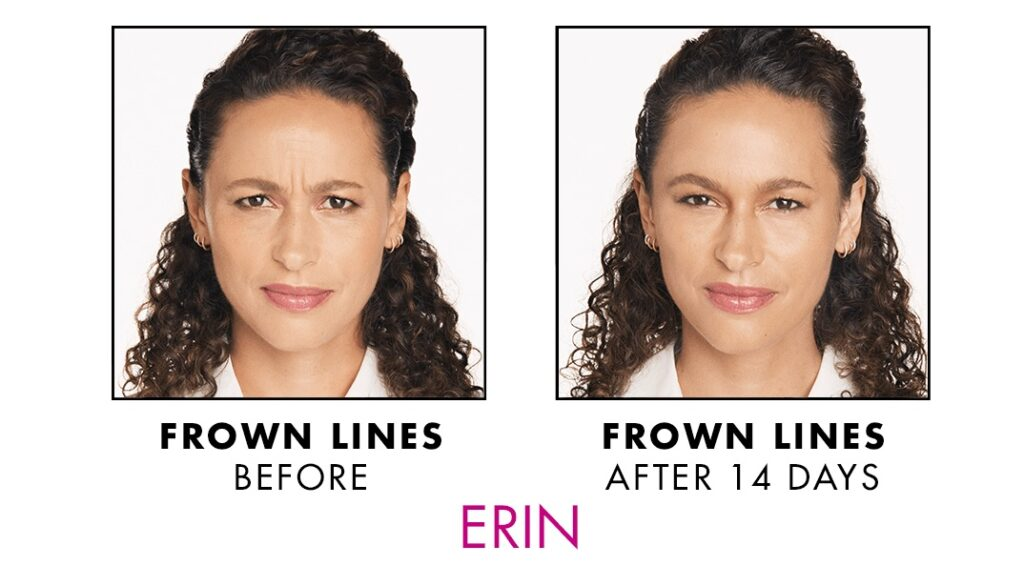 Xeomin before and after woman 2