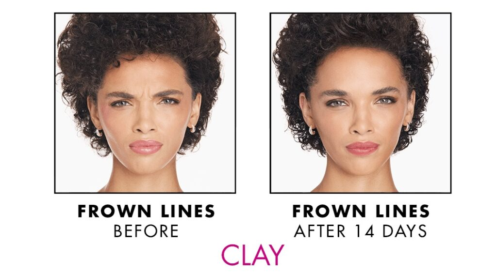 Xeomin before and after woman 3