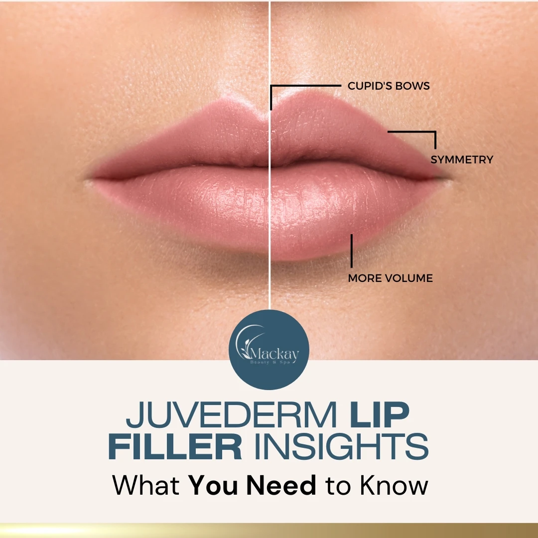 Mackay lip filler educational graphic illustrating lip definition, symmetry, and volume
