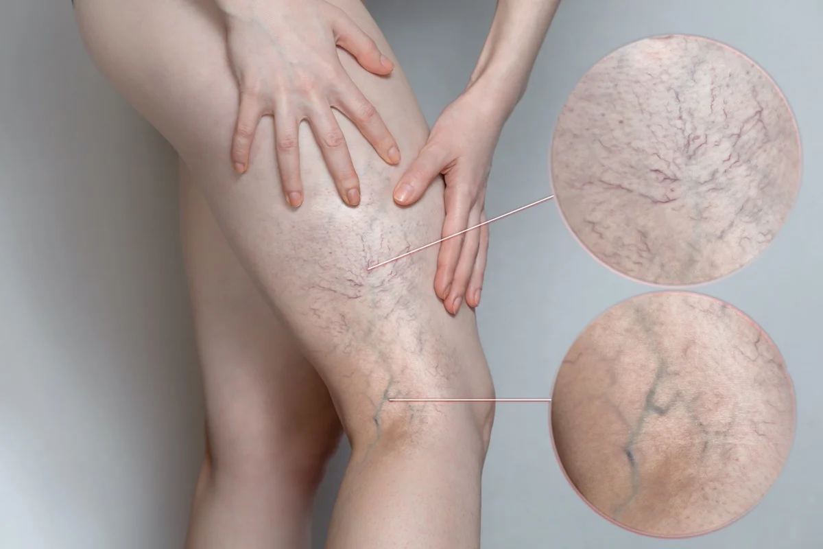 Illustration of leg veins with magnified views of small surface veins and larger visible veins