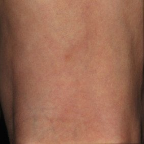 After spider vein treatment: the corresponding leg area from the practice gallery