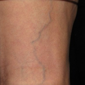 Before spider vein treatment: visible veins on the leg