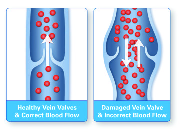 normal vs varicosed vein