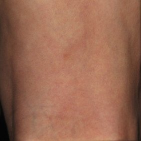 reticular-spider-vein-treatment-after-drmackay-1