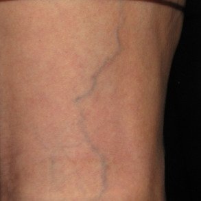 reticular-spider-vein-treatment-before-drmackay-1
