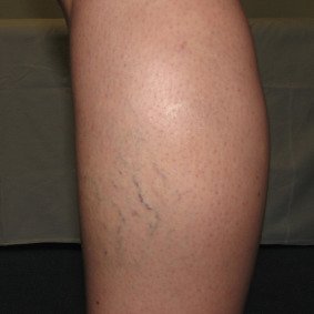 reticular-spider-vein-treatment-before-drmackay-2