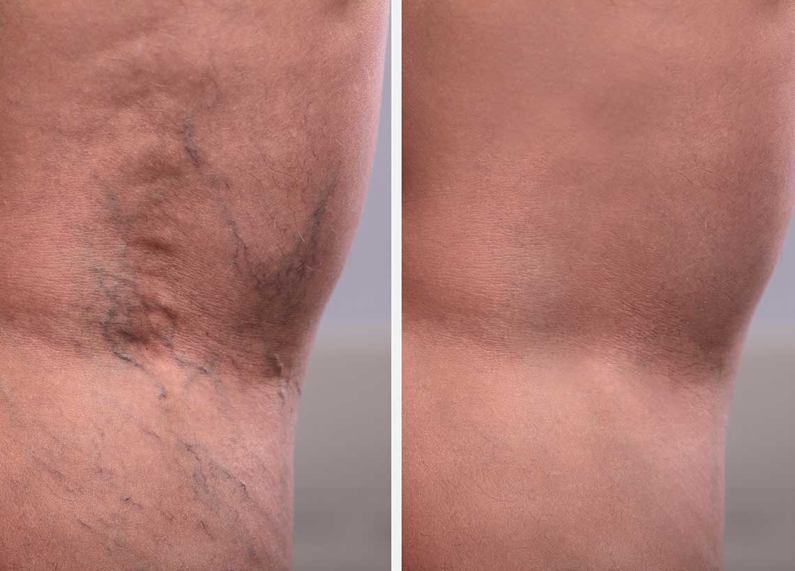 peripheral vein treatment spider vein before after mackay tampa