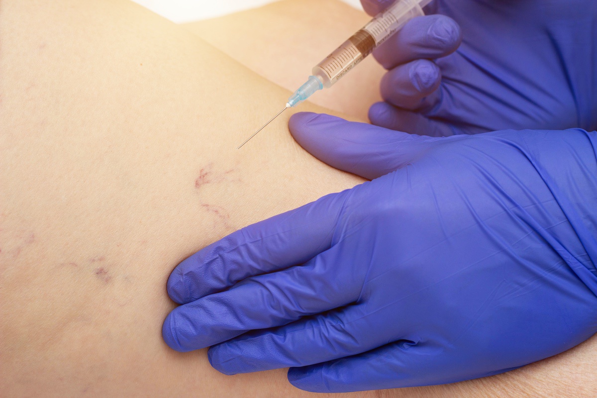 sclerotherapy injection for spider vein in the leg