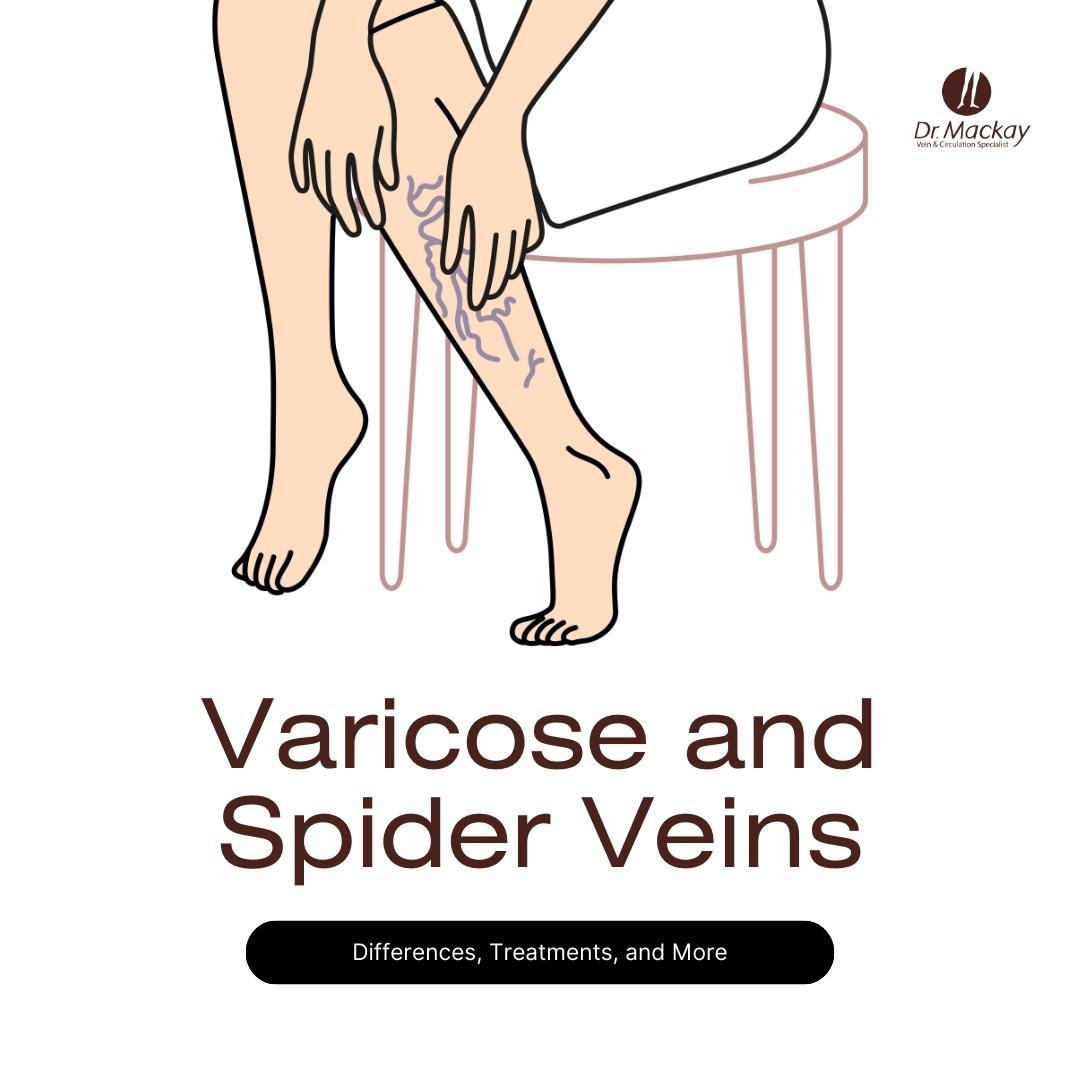 spider veins vs varicose veins comparison guide banner 2