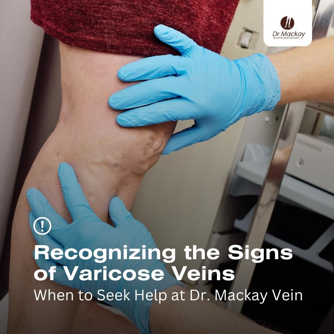 varicose vein leg exam