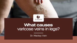 What causes varicose veins in legs