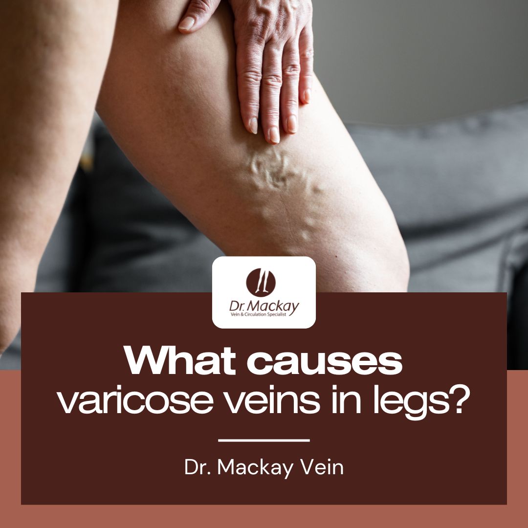 What causes varicose veins in legs