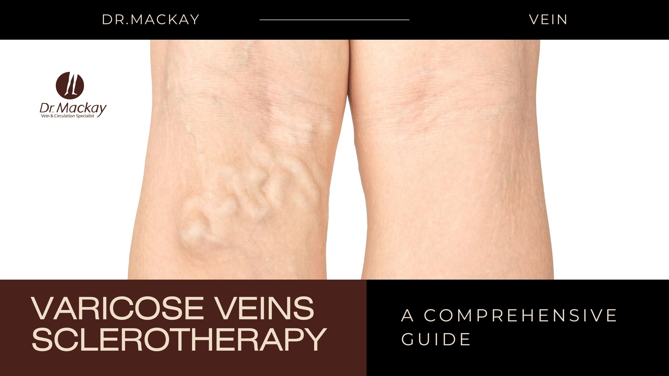 varicose veins sclerotherapy
